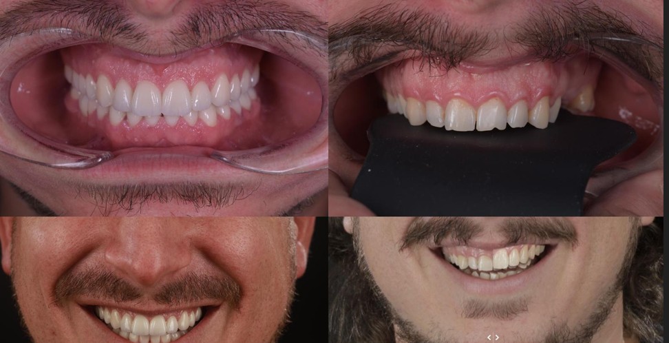 VisionSmile voorbeeld
